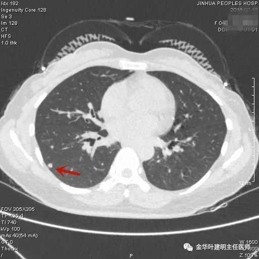 叶建明谈胸膜下的实性结节,叶建明肺实性良性结节会变癌症吗