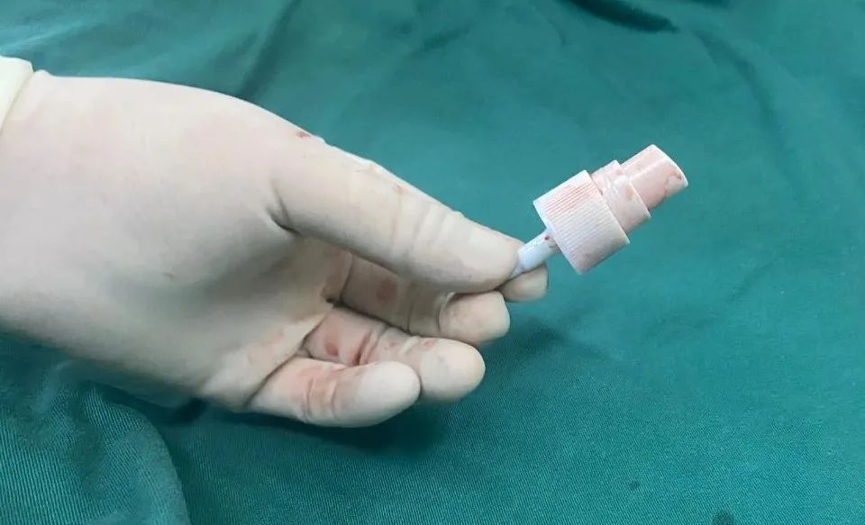 【呱呱教76】惊现！8岁女童体内竟藏有香水瓶喷头