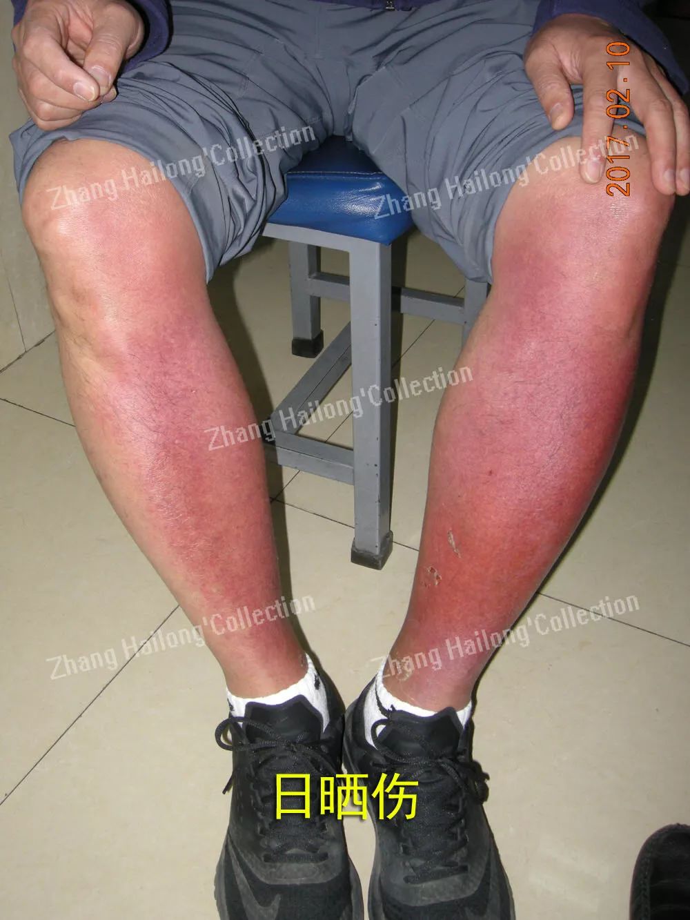 晒太阳两分钟会被紫外线伤到吗,太阳太晒如何防护