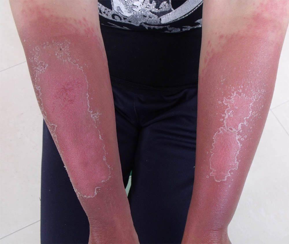 放疗与化疗有没有区别,放疗和化疗的区别到底有多大