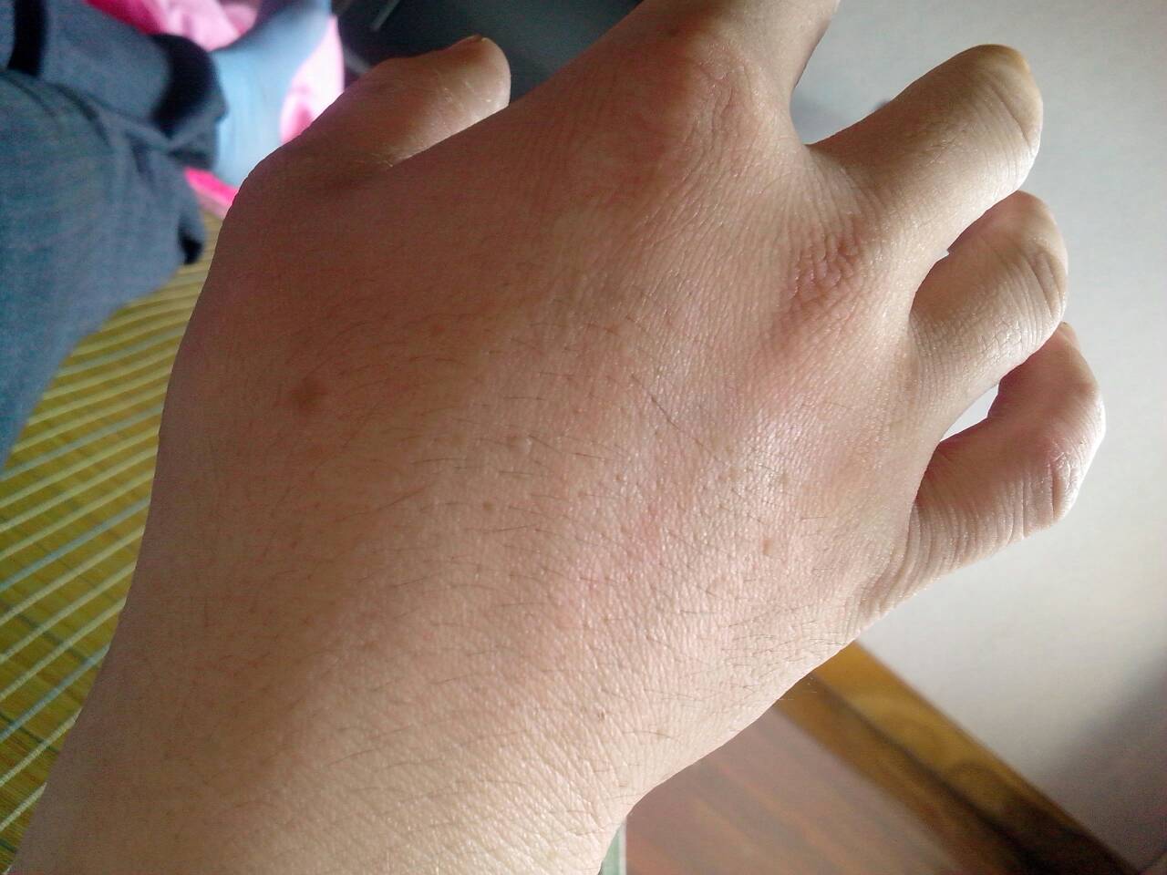 板层状鱼鳞病怎么引起,板层状鱼鳞病是单基因吗