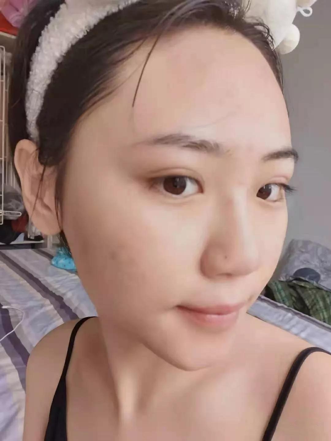 深圳治痘痘皮肤科哪个医院好啊,去皮肤科看痘痘好不好