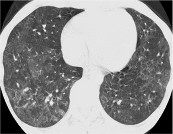 间质性肺疾病看病经验分享,分享肺腺癌临床实验的例子