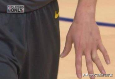 打球手指戳伤怎么判断有没有脱臼,打球手指弯曲变形怎么办