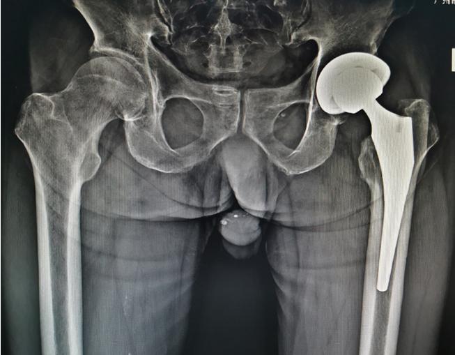 股骨颈骨折导致股骨头坏死的原因,股骨颈骨折如何避免股骨头坏死