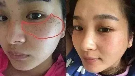 鼻子长痘是胃不好吗,鼻子长痘是肝火还是胃火