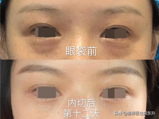 祛眼袋内切手术推荐一下,祛眼袋手术后悔的真实经历