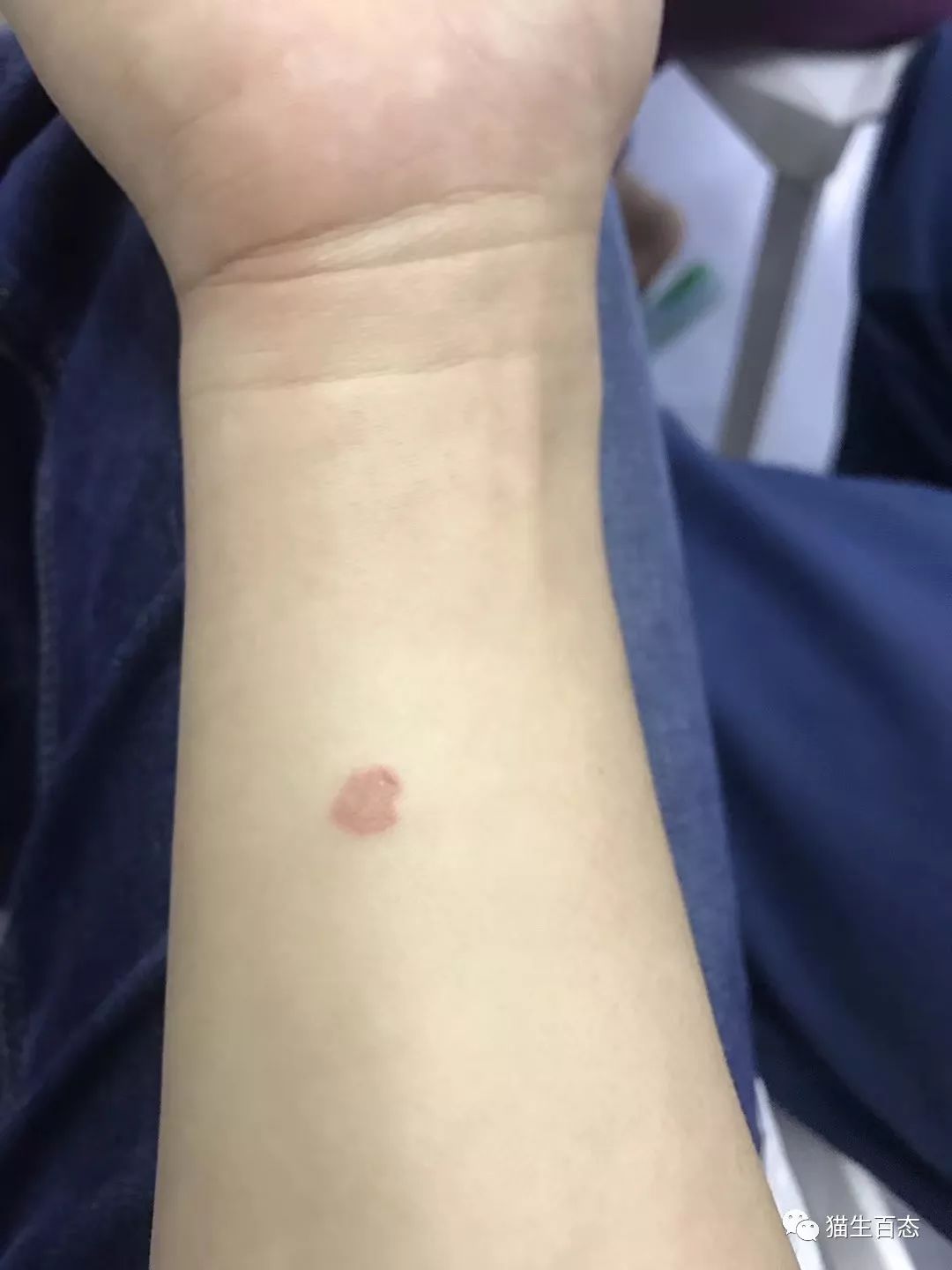 猫癣有那么可怕吗,最可怕的猫癣