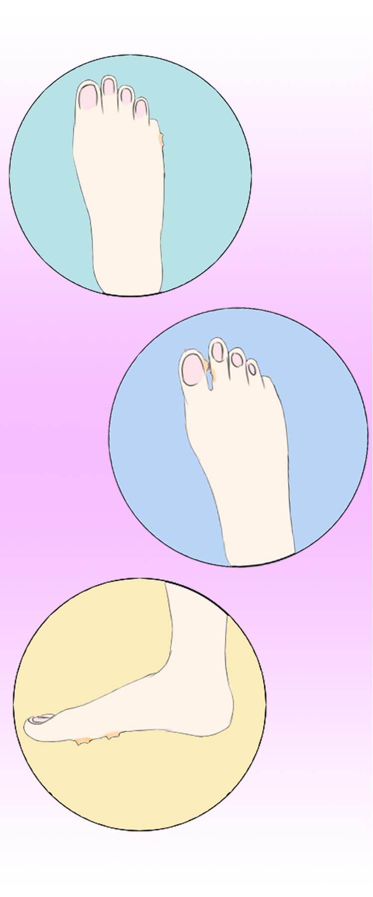 脚上长鸡眼了怎么办不影响走路,脚上长鸡眼不疼怎么治