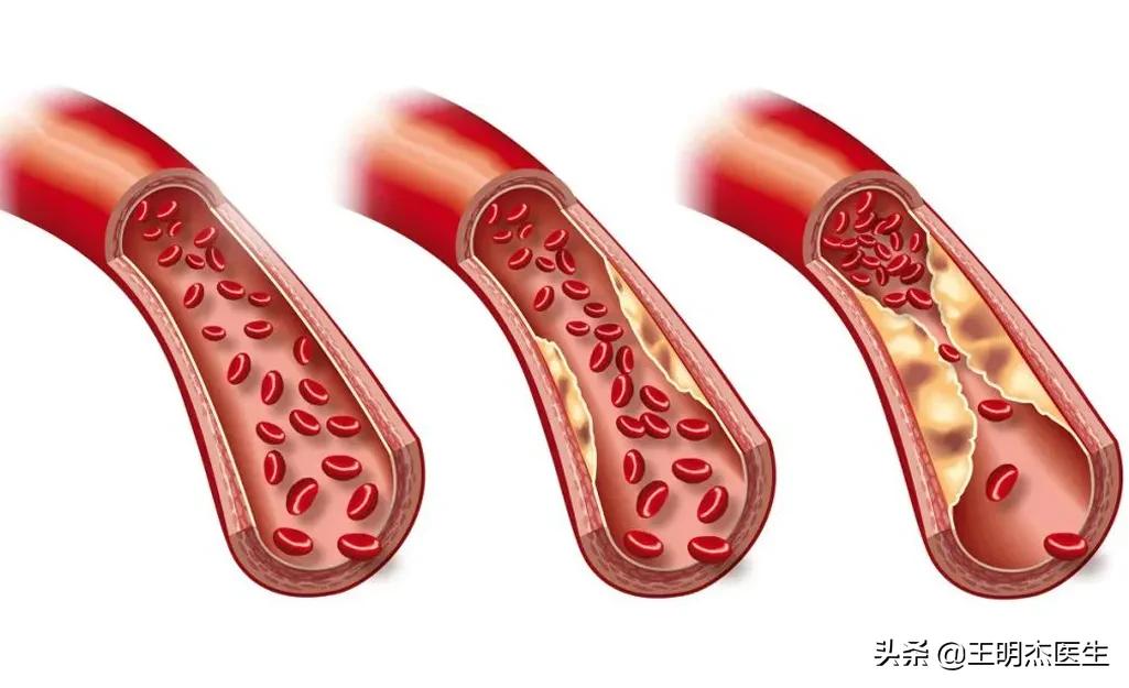 下肢动脉血栓晚上疼痛厉害,下肢动脉栓塞会引起膝盖困疼