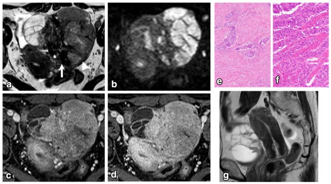 卵巢实性为主肿瘤，这13种你都想到了吗？