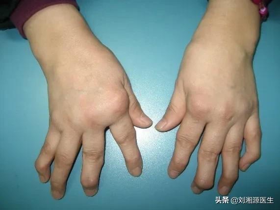 【免疫相关不良妊娠答疑解惑18】——类风湿关节炎(上)