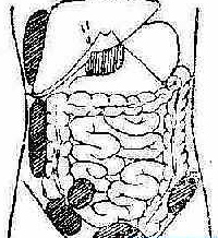 小肚子痛阑尾部位有轻微痛,小阑尾炎的症状