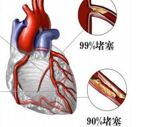 血瘀容易引发的三种疾病,血瘀会引起哪些妇科疾病