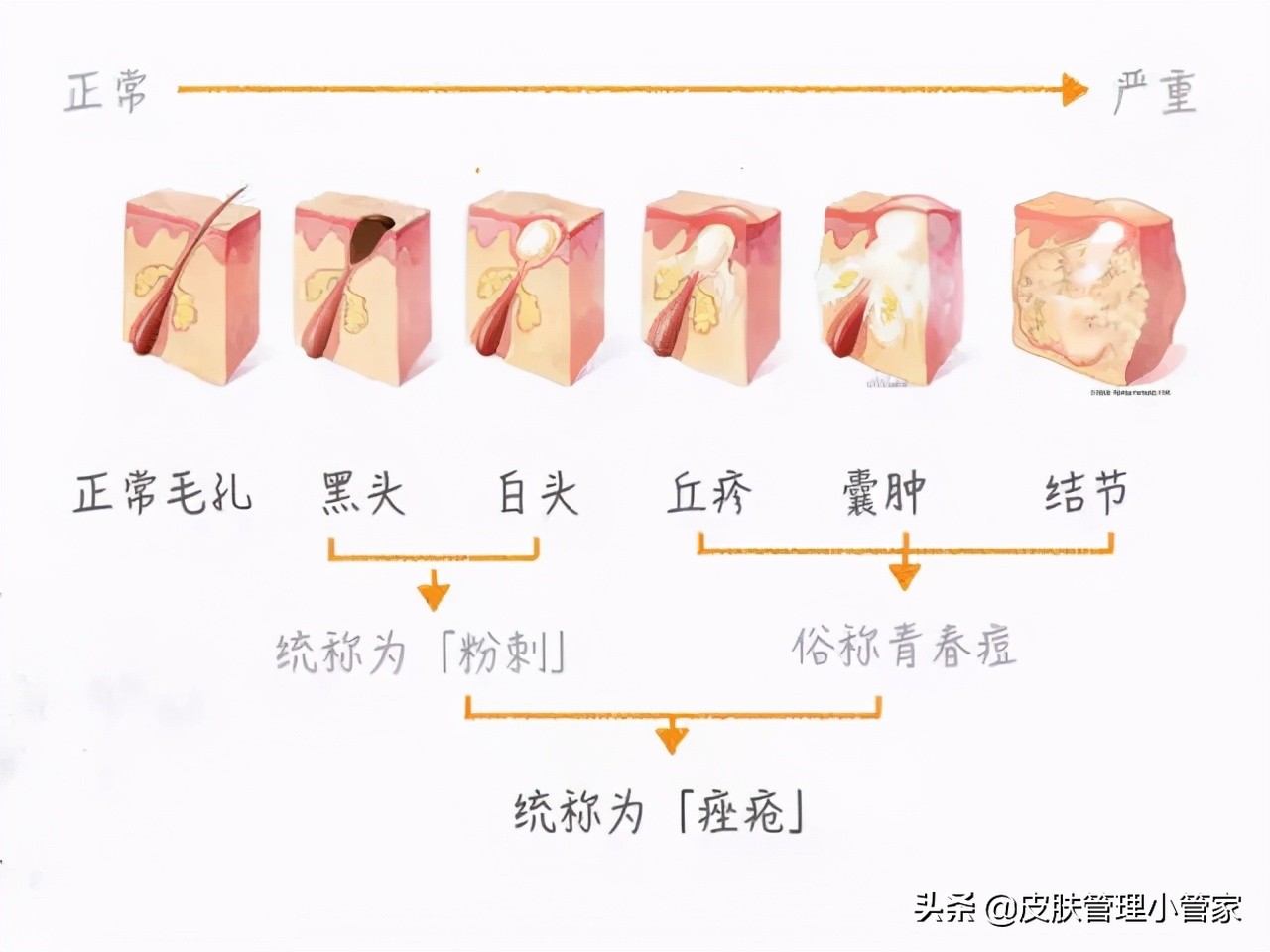 祛斑祛痘皮肤管理,皮肤管理祛痘有效吗