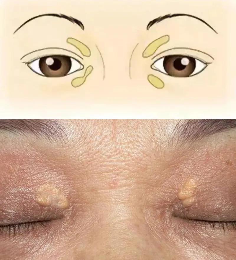 心血管病人眼睛肿怎么回事,心血管疾病引起眼皮水肿严重吗