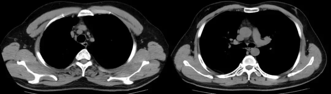 青年男性肺炎过后一直咳嗽怎么办,潜伏结核感染咳嗽咳痰