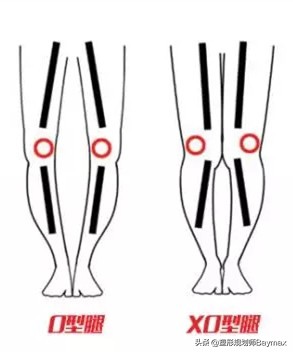 改善xo型腿最有效的训练方法,xo型腿和假性o型一样吗