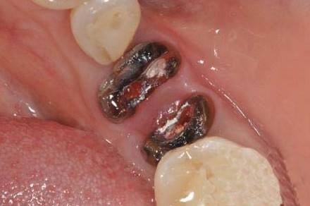 烤瓷牙崩瓷的正确处理方法,烤瓷牙崩瓷了怎么修