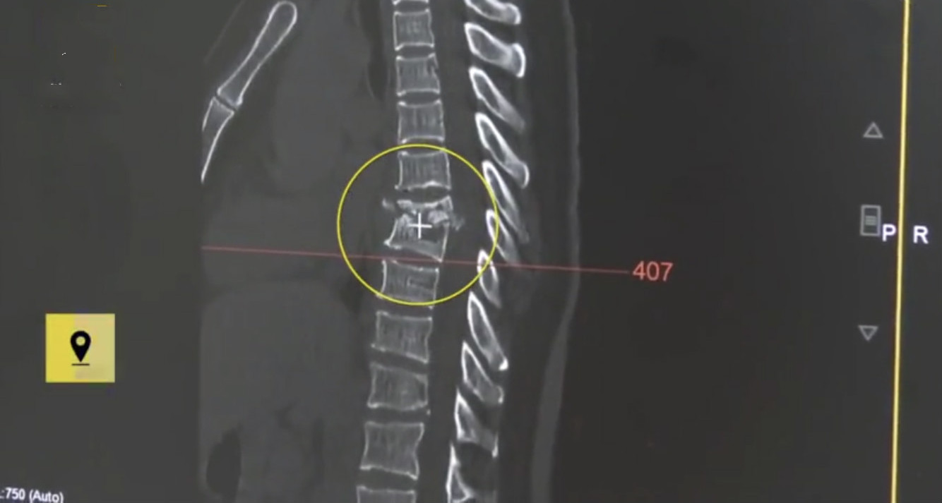 腰背疼痛当心骨质疏松,腰背痛或是骨质疏松