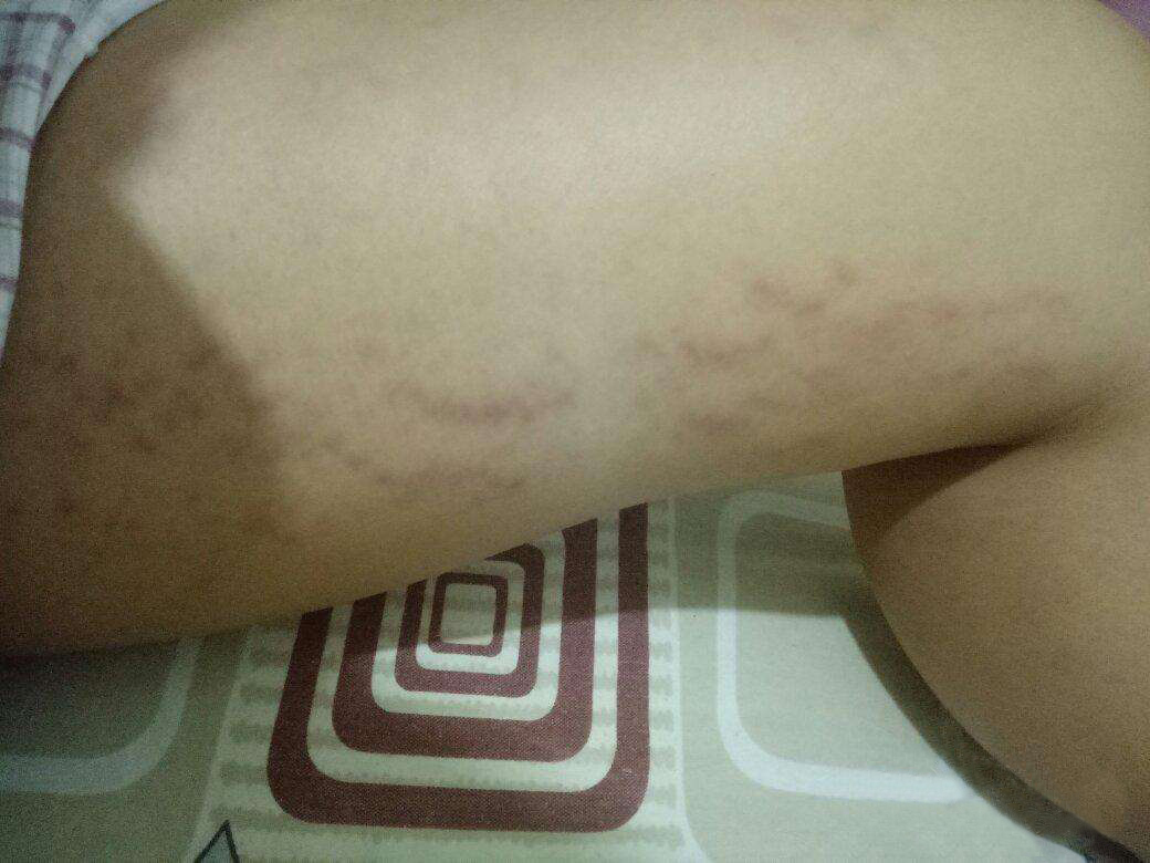 怎么样预防妊娠纹最有效,预防妊娠纹有什么好方法