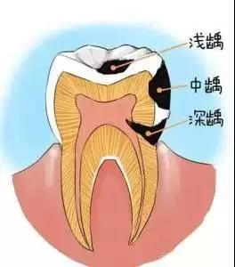 补牙前牙疼补牙后还疼的原因,补牙前不痛补牙后痛怎样处理
