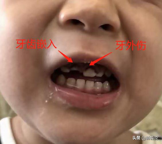 宝宝喊牙疼上嘴唇肿了是什么原因,宝宝牙疼为什么晚上疼得厉害