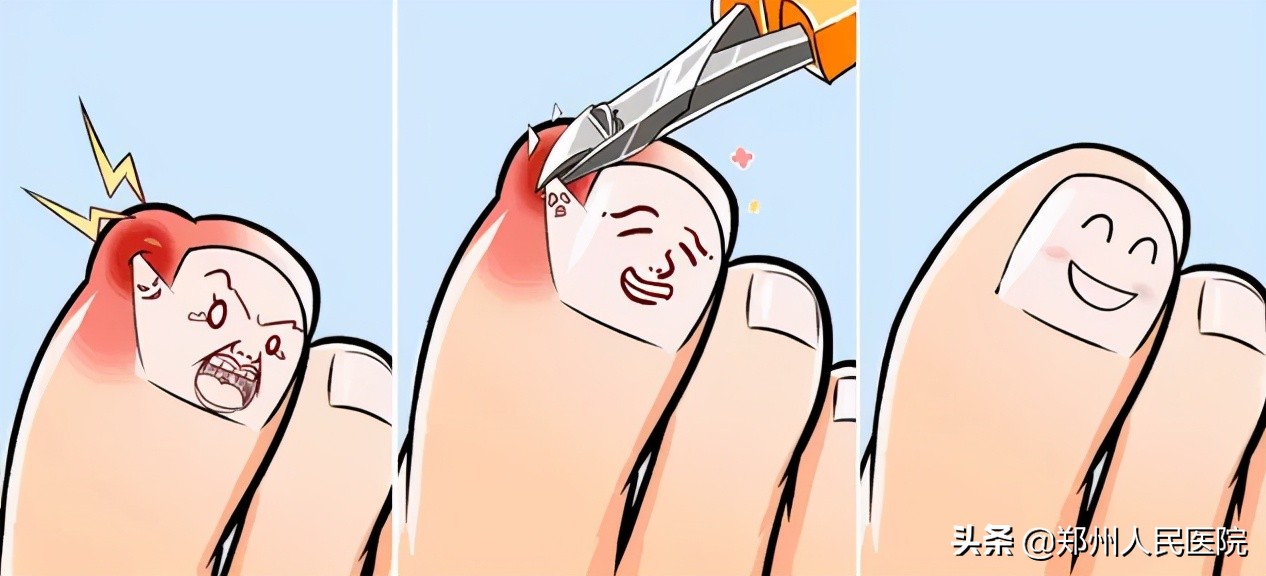 拔甲之后到底该怎么剪指甲,拔指甲疼得尖叫