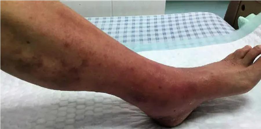 足癣不是真菌感染怎么治,足癣怎么治疗好得快