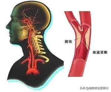 生命健康有哪些方面,临床症状脑血栓形成