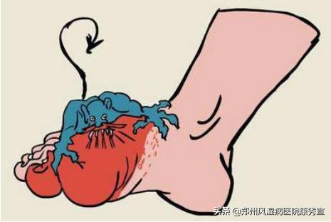 痛风发作怎么可以快速缓解,痛风突然发作怎么样可以马上止痛