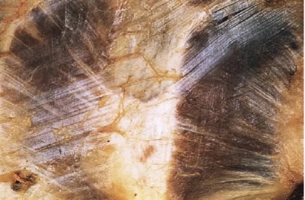 前叉术后不掰腿能不能恢复正常,前叉重建术后康复必须天天掰腿吗