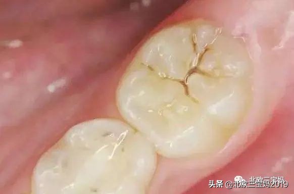 3岁儿童全麻做根管有影响吗,宝宝捆绑治疗蛀牙