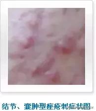痘痘十大真相,痘痘大全图解