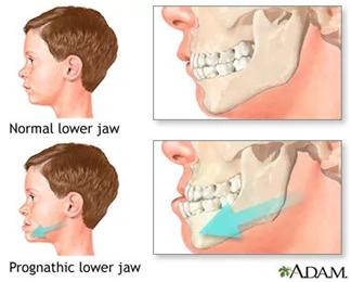 孩子嘴巴地包天有什么说法吗,小孩嘴地包天