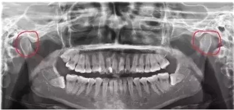两侧脸不对称是病吗,脸部百分之一的不对称正常吗