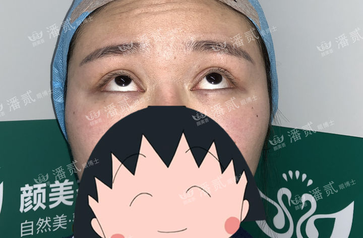 开眼角过大图片,开眼角过大修复效果图