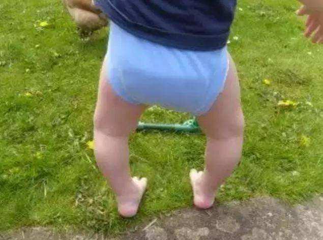 平躺膝盖并不拢怎么回事,两膝盖并不拢怎么办