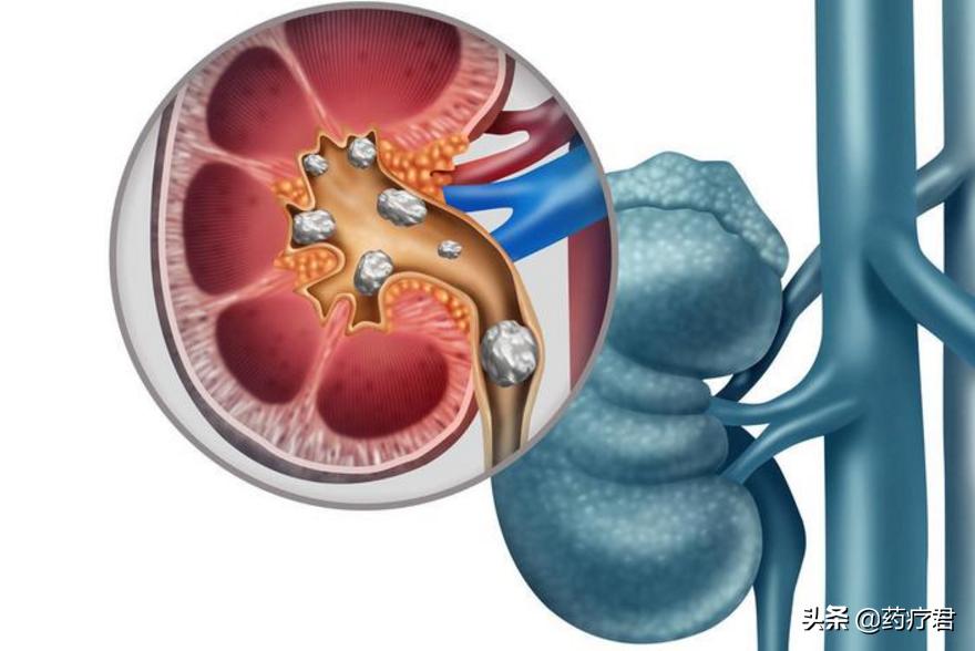 尿酸值从370忽然降到150,尿酸高达500吃什么药