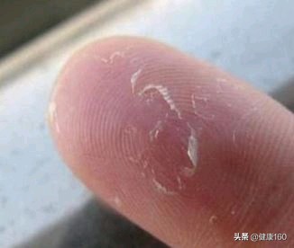 手部季节性脱皮有哪几种,手部脱皮严重是什么样的