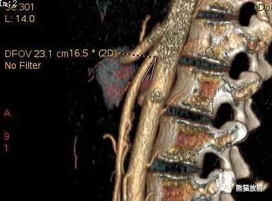 十二指肠球部溃疡解剖位置,十二指肠球部溃疡x线表现