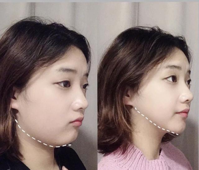 如何消除双下巴让脸型更好看,下巴松弛造成的双下巴面相