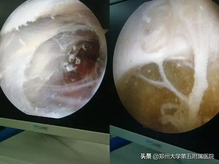 腘窝囊肿用针灸和蜡疗能治好吗,腘窝囊肿手术切口如何选择