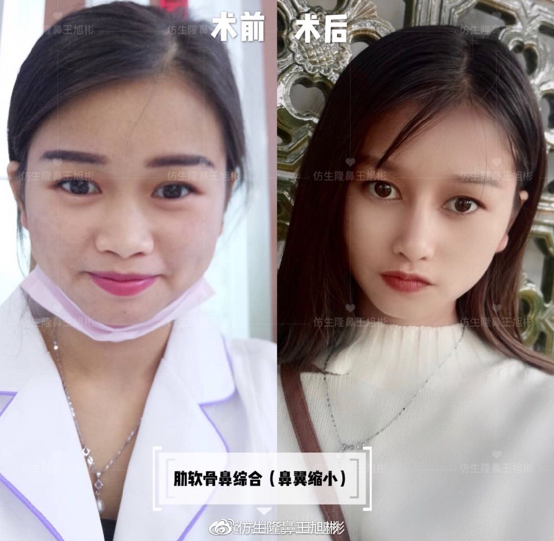 短鼻整形手术,鼻整形短鼻