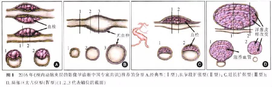 密网支架治疗脑动脉瘤术后效果图,密网支架治疗基底动脉假性动脉瘤