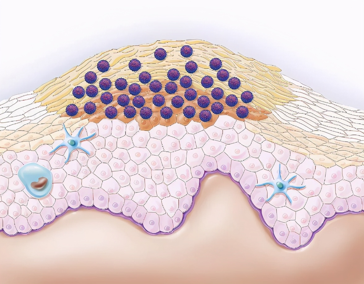 hpv高危52阳性持续2年未转阴,hpv持续感染3年多了不转阴怎么办