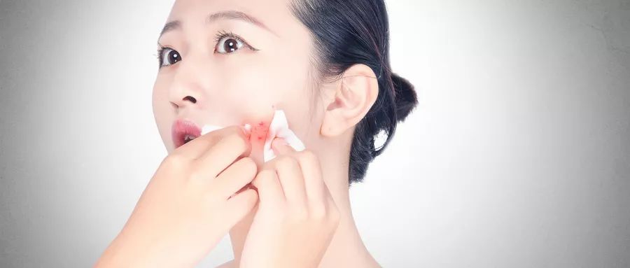 痘痘怎么防治小妙招,痘痘怎么治疗最快最有效