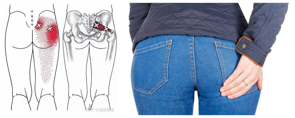 屁股痛、腿麻,有块肌肉受伤了