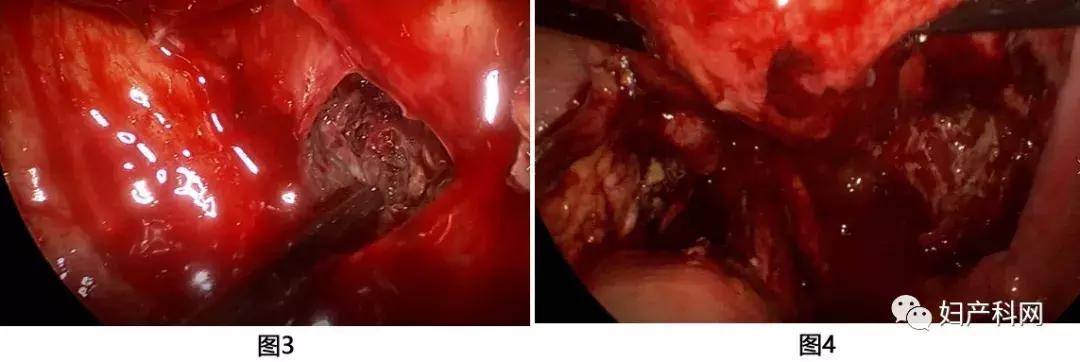 病例分析室|NO.16盆腔脓肿病案分析