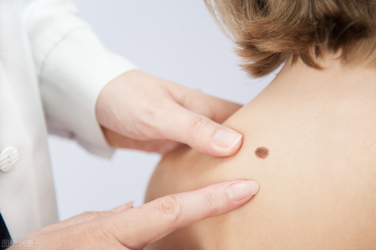 点痣留的疤能去掉吗,点痣抠掉了会留疤吗